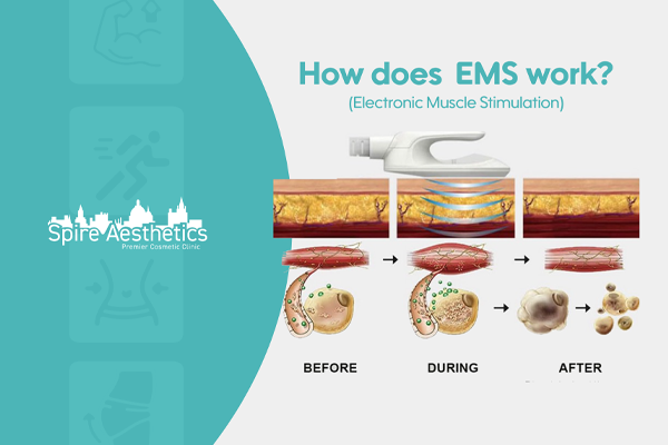 EMS treatment for post pregnancy weight loss treatment Doncaster