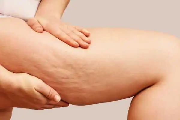 Image of woman showing leg with cellulite Doncaster
