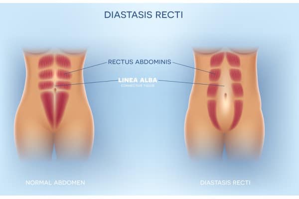 How Does Non-Surgical Treatment Help With Loose Skin, Weak Abdominal Muscles and Post-Pregnancy Changes Doncaster?