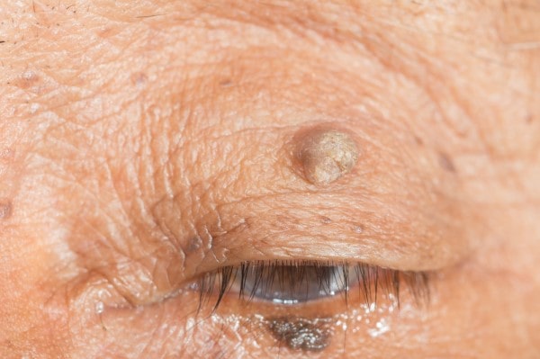 Skin imperfections Doncaster - Cryopen is fast and effective book in today!