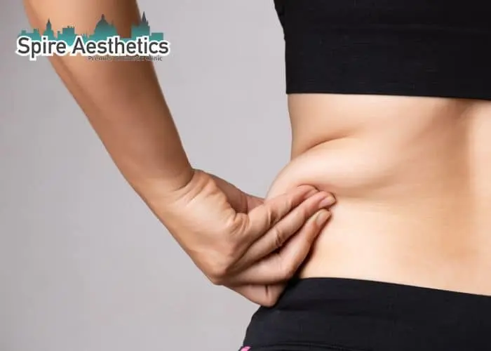 Image of woman pinching fat on their hips Doncaster. Fat Freezing treatment
