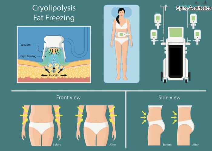 Image of diet and fat freezing combined for best results for Spire Aesthetics Doncaster