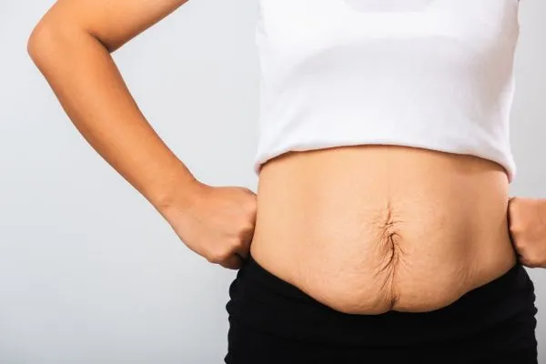 Image of a woman's stomach after weight loss with sagging skin following a gastric band Doncaster