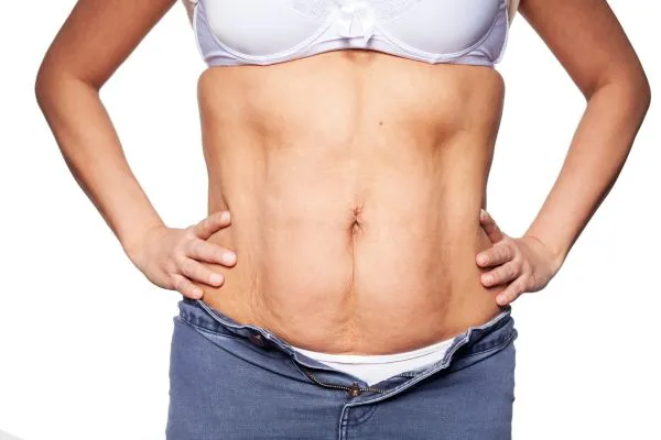 sagging skin on woman's stomach after weight loss injections Doncaster