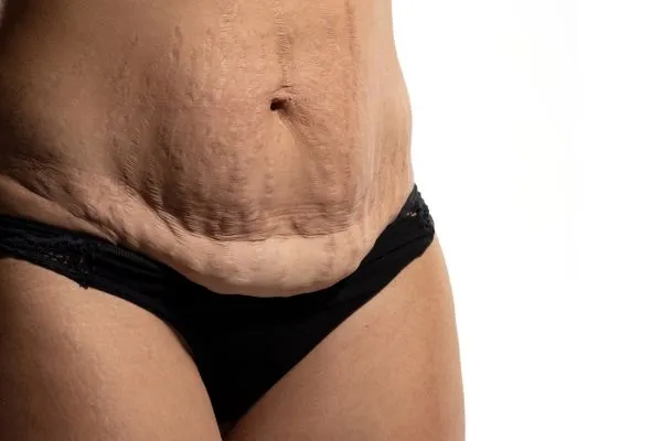 Image of womans stomach after weight loss injections Doncaster showing saggy skin