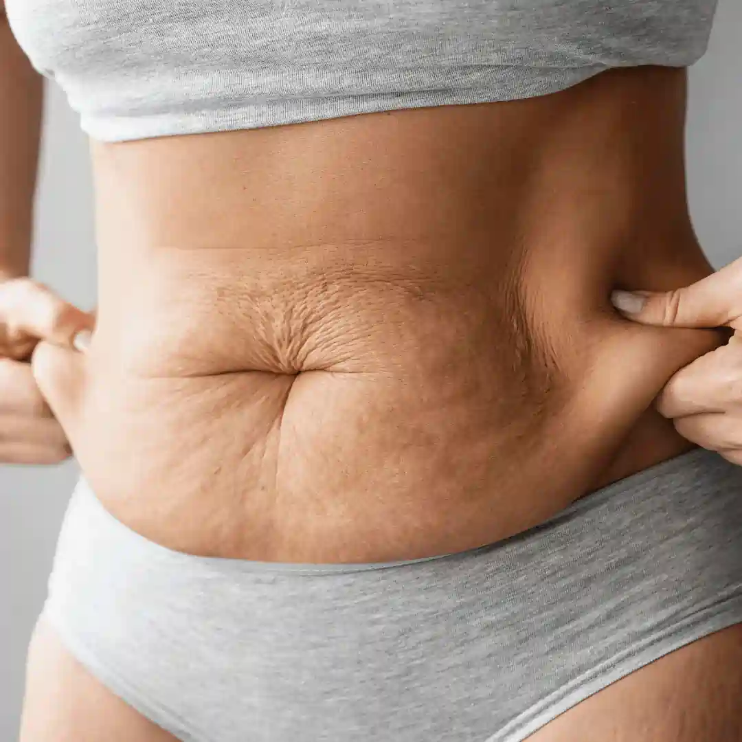 Is It Normal to Have Loose Skin After Pregnancy Doncaster?