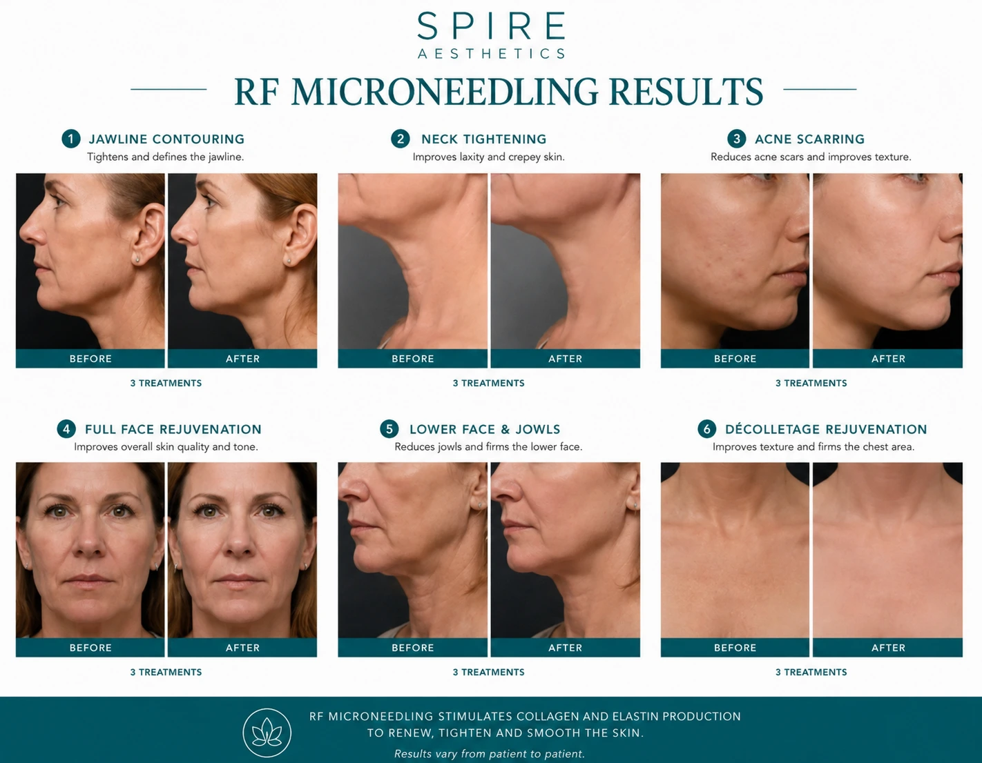 RF Microneedling Skin tightening Doncaster results