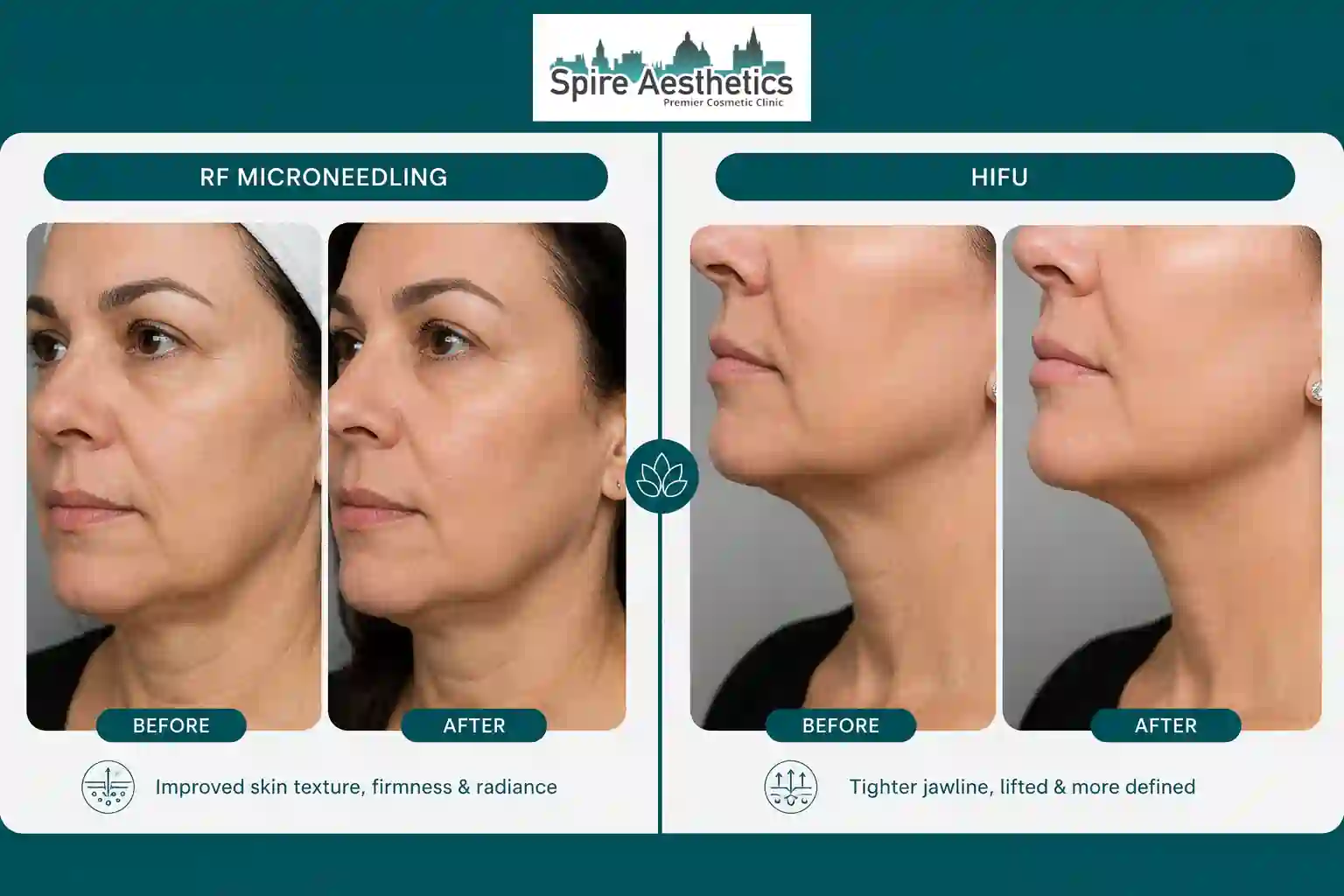 Can RF Microneedling and HIFU Be Combined Doncaster?