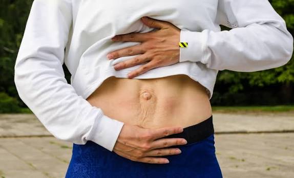 When Could Diastasis Recti Be the Missing Piece of the Puzzle Doncaster?
