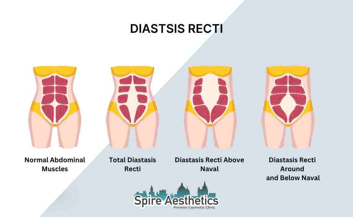 Is Non-Surgical Diastasis Recti Treatment Right for You? Common Concerns Answered Doncaster